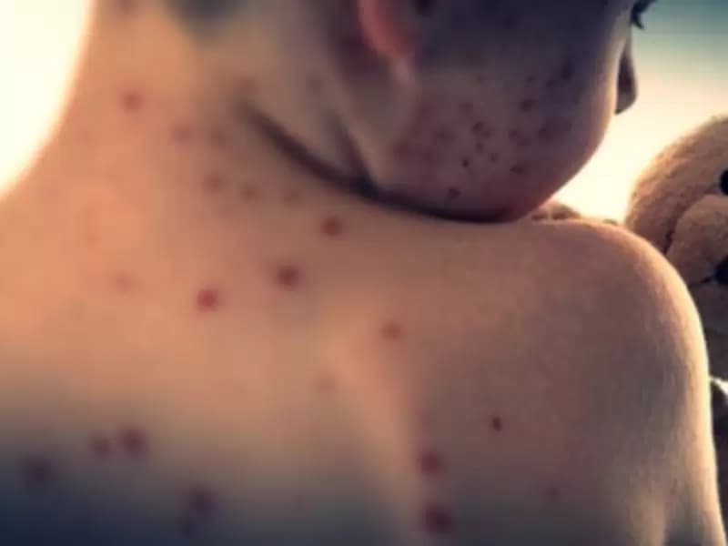 U.S. reports over 2,000 measles cases in 2025, highest since 1992